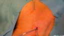 Bard Groshong Catheter Insertion