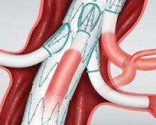 Cook Medical | Zenith t-Branch Thoraco Abdominal Stent Graft