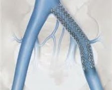 Cook Medical | Zilver Vena Self Expanding Stent