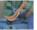 Ankle replacement | Which Medical Device